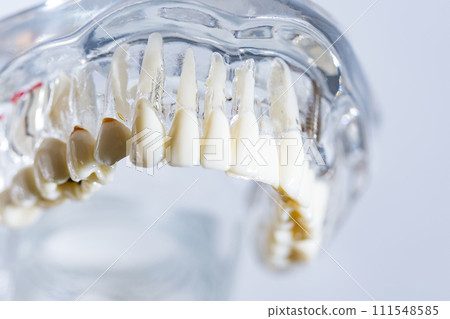 Dental implant, artificial tooth roots into jaw, root canal of dental treatment Dental implant, artificial tooth roots into jaw, root canal of dental treatment 111548585