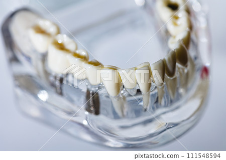 Dental implant, artificial tooth roots into jaw, root canal of dental treatment Dental implant, artificial tooth roots into jaw, root canal of dental treatment 111548594