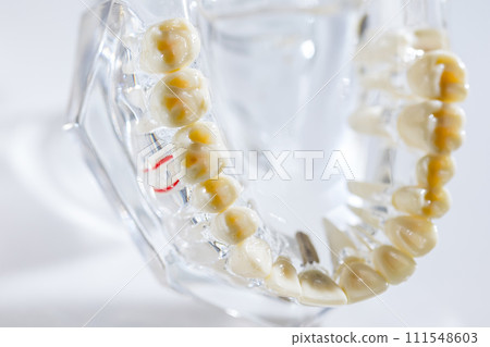 Dental implant, artificial tooth roots into jaw, root canal of dental treatment Dental implant, artificial tooth roots into jaw, root canal of dental treatment 111548603