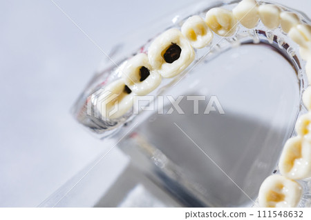 Caries tooth model, oral care concept. Problems with teeth health Caries tooth model, oral care concept. Problems with teeth health 111548632