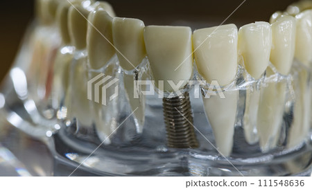 Dental implant, artificial tooth roots into jaw, root canal of dental treatment 111548636