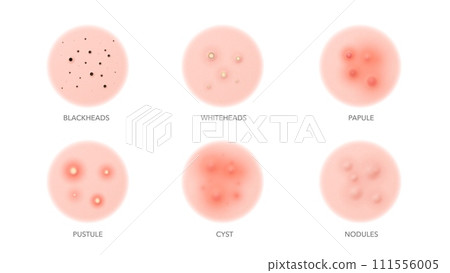Acne types, body or face skin pimples and inflammation problems, vector icons. Acne types, blackhead, pustule or whitehead, papule and cyst with nodules for skincare beauty cosmetology and dermatology Acne types, body or face skin pimples and inflammation problems, vector icons. Acne types, blackhead, pustule or whitehead, papule and cyst with nodules for skincare beauty cosmetology and dermatology 111556005