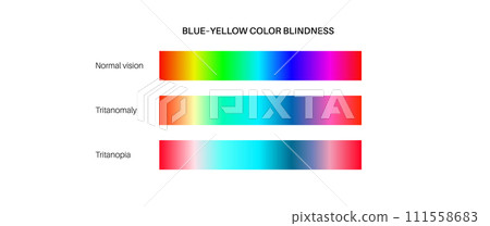 Tritanopia and tritanomaly 111558683