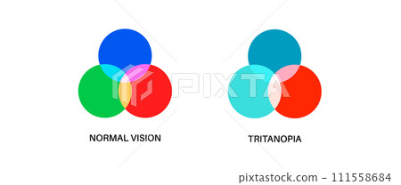 Tritanopia and tritanomaly 111558684