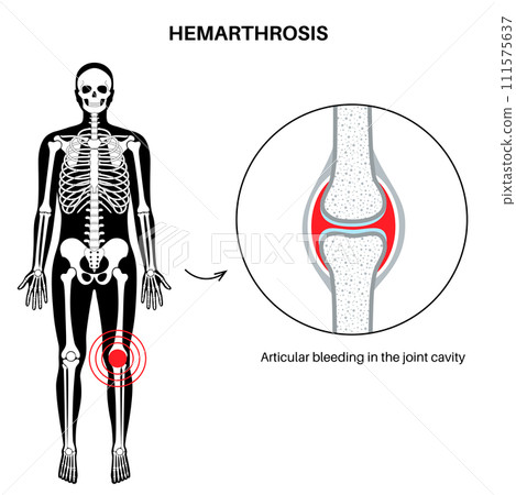 Hemarthrosis in the synovial joint Hemarthrosis in the synovial joint 111575637