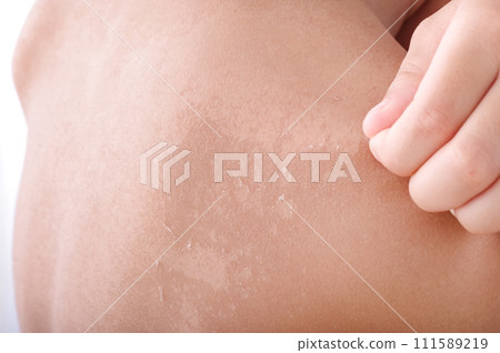 剝去曬傷肌膚的人 剝去曬傷肌膚的人 111589219