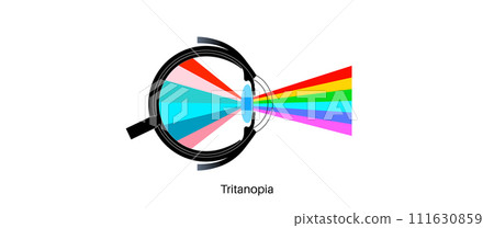 Tritanopia and tritanomaly 111630859