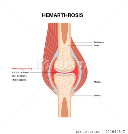 Hemarthrosis in the synovial joint 111644847