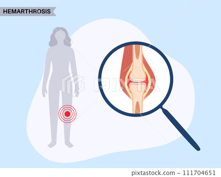 Hemarthrosis in the synovial joint 111704651