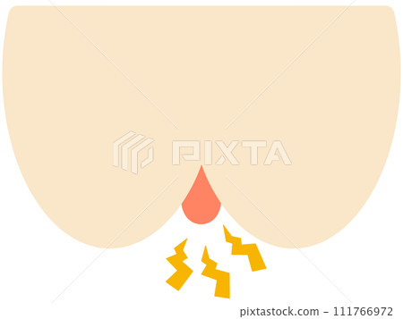 hemorrhoid mark hemorrhoid mark 111766972