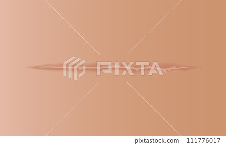 Healing wounds, skin scar, stitched gash and cut. Realistic surgical suture, stitched wounds. Healing stage on human skin background. Vector illustration Healing wounds, skin scar, stitched gash and cut. Realistic surgical suture, stitched wounds. Healing stage on human skin background. Vector illustration 111776017