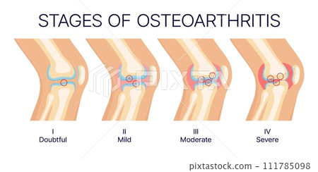 Knee osteoarthritis stages, human knee joints and bones anatomy. Vector medical diagram of arthritis disease stages with healthy and injured cartilages, arthritic inflammation, medicine themes 111785098