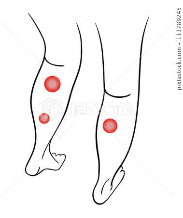 Varicose veins of the legs. Treatment of varicose veins. 111789245