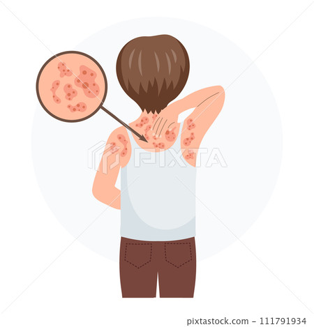Allergic itching, skin inflammation, redness and irritation. A child with allergies. Healthcare and medicine. Vector 111791934