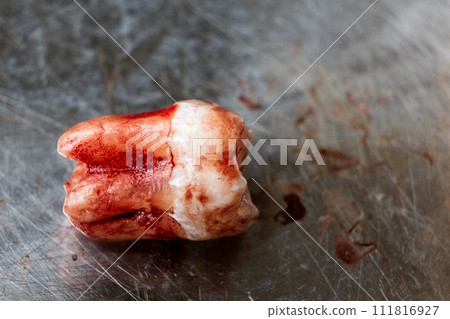 Freshly extracted molar wisdom tooth with blood stain with focus on roots placed on stainless stell container Freshly extracted molar wisdom tooth with blood stain with focus on roots placed on stainless stell container 111816927