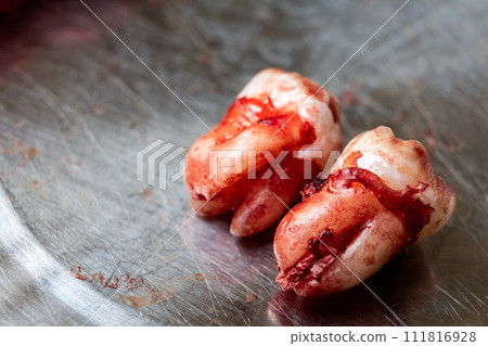 Freshly extracted molar wisdom teeth with blood stain with focus on roots, placed on stainless stell container Freshly extracted molar wisdom teeth with blood stain with focus on roots, placed on stainless stell container 111816928