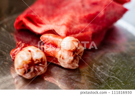 Freshly extracted molar wisdom tooth with blood stain focused on roots placed on stainless stell container 111816930