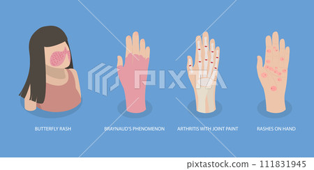 3D Isometric Flat Vector Illustration of Systemic Lupus Erythematosus 111831945