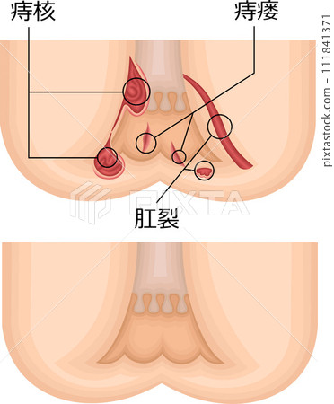 肛門痔瘡圖解中文 111841371