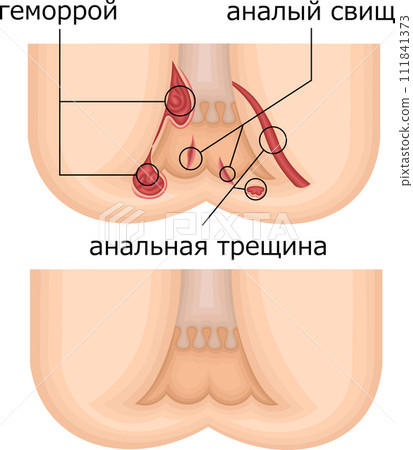Anus hemorrhoid illustration Russian 111841373