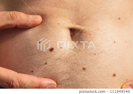 Male hand showing birthmarks on skin body stomach part. Close up detail of the bare skin. Health Effects of UV Radiation. Man with birthmarks Pigmentation Male hand showing birthmarks on skin body stomach part. Close up detail of the bare skin. Health Effects of UV Radiation. Man with birthmarks Pigmentation 111849540