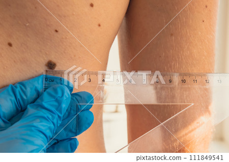 Dermatologist checking sizes of male birthmarks with ruler. Doctor examining length and width of benign moles on man skin Dermatologist checking sizes of male birthmarks with ruler. Doctor examining length and width of benign moles on man skin 111849541
