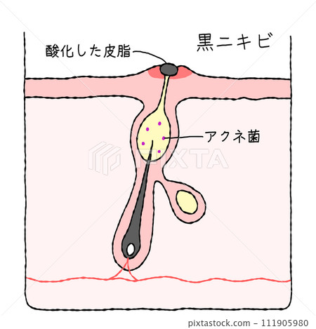 痘痘結構: 黑色痘痘 痘痘結構: 黑色痘痘 111905980
