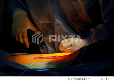 In operating room, doctors stitch up leg after it has been injured 111922172