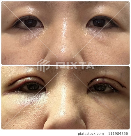 雙眼皮前後對比 111984866