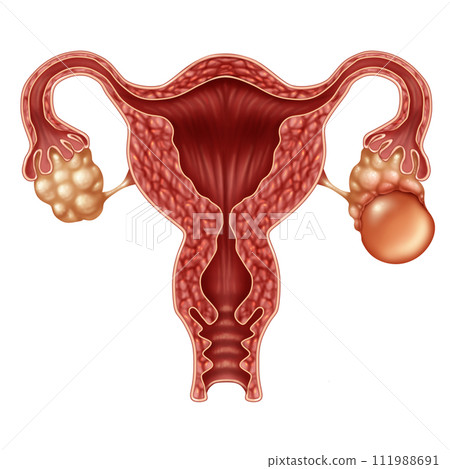 Ovarian Cyst Ovarian Cyst 111988691
