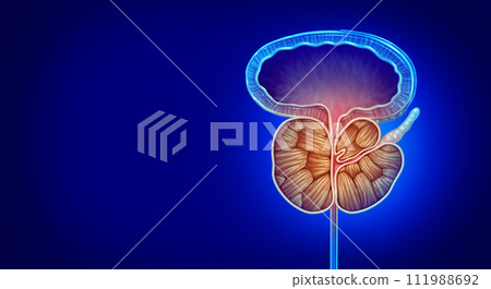 Prostate That Is Enlarged Prostate That Is Enlarged 111988692
