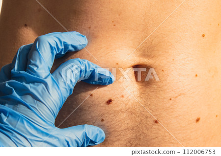 Dermatologist checking male birthmarks. Doctor in medical gloves examining man skin mole. Self care preventing cancer procedure. Protection treatment. Imperfection skin 112006753