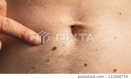Male hand showing birthmarks on skin body stomach part. Close up detail of the bare skin. Health Effects of UV Radiation. Man with birthmarks Pigmentation 112006754
