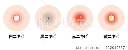 痤瘡的類型 112010337