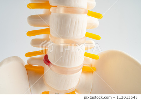 Lumbar spine displaced herniated disc fragment, spinal nerve and bone. Model for treatment medical in the orthopedic department. Lumbar spine displaced herniated disc fragment, spinal nerve and bone. Model for treatment medical in the orthopedic department. 112013543