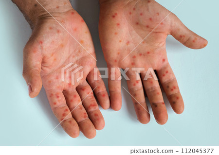 Human Hands with Painful Rash, Red Spots Blisters on the Skin. Health Problem. Monkeypox Disease Symptoms. Male Patient Arms with Monkey Pox. Close Up. Banner, Copy Space. Dengue Fever Infection, MPOX 112045377