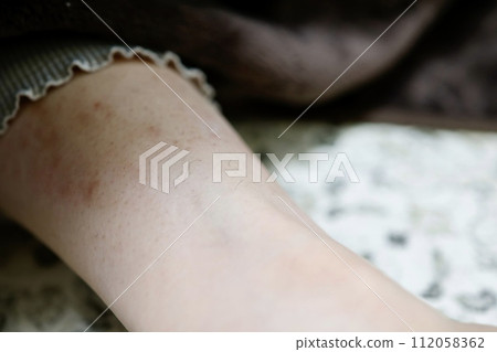 女性未剃須的脛毛和剃刀燒傷的皮膚 女性未剃須的脛毛和剃刀燒傷的皮膚 112058362