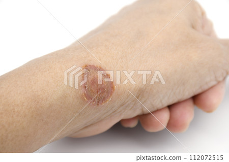 Microsporum canis lesion, a fungus infections on human skin transmitted by contact. Microsporum canis lesion, a fungus infections on human skin transmitted by contact. 112072515
