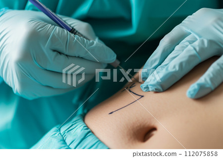 doctor do the surgery line on the belly with generative ai 112075858