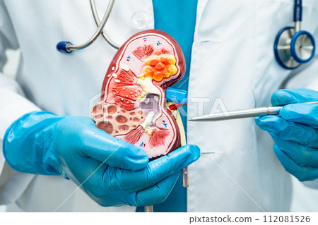 Kidney disease, Chronic kidney disease ckd, Doctor hold human model to treat and study in hospital. Kidney disease, Chronic kidney disease ckd, Doctor hold human model to treat and study in hospital. 112081526