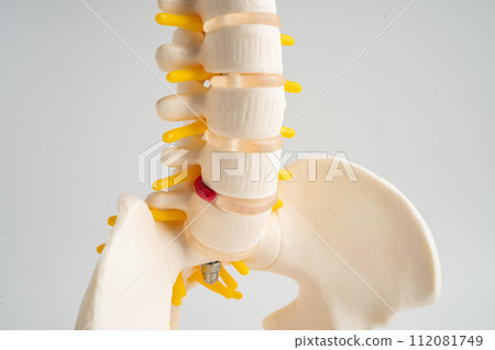 Lumbar spine displaced herniated disc fragment, spinal nerve and bone. Model for treatment medical in the orthopedic department. Lumbar spine displaced herniated disc fragment, spinal nerve and bone. Model for treatment medical in the orthopedic department. 112081749