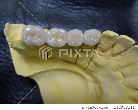 陶瓷牙/牙科技術用金屬結合劑模型/排列整齊的白牙 112098111