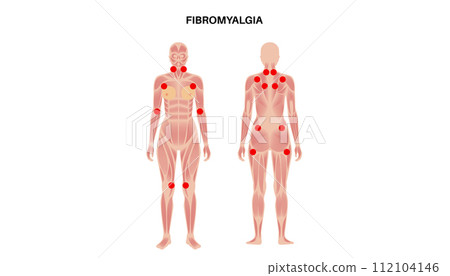Fibromyalgia medical poster 112104146