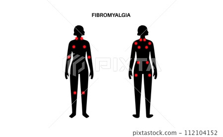 Fibromyalgia medical poster Fibromyalgia medical poster 112104152