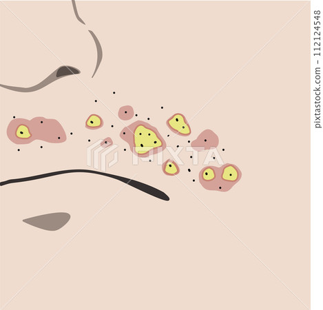 Folliculitis in the beard on the mouth of a man 112124548