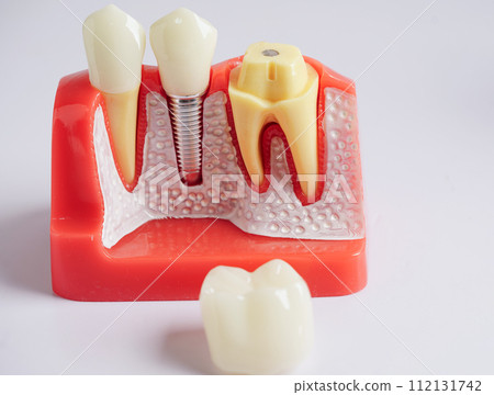 Dental implant, artificial tooth roots into jaw, root canal of dental treatment, gum disease, teeth model for dentist studying about dentistry. Dental implant, artificial tooth roots into jaw, root canal of dental treatment, gum disease, teeth model for dentist studying about dentistry. 112131742