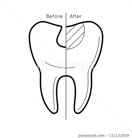 Tooth before and after caries 112132059