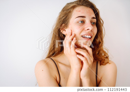 Close-up portrait of a beautiful woman without makeup with imperfect skin. Acne skin. Natural beauty 112191443