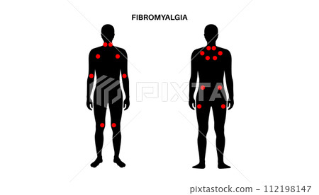 Fibromyalgia medical poster 112198147