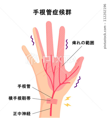 Causes of carpal tunnel syndrome and range of numbness Vector illustration 112202196